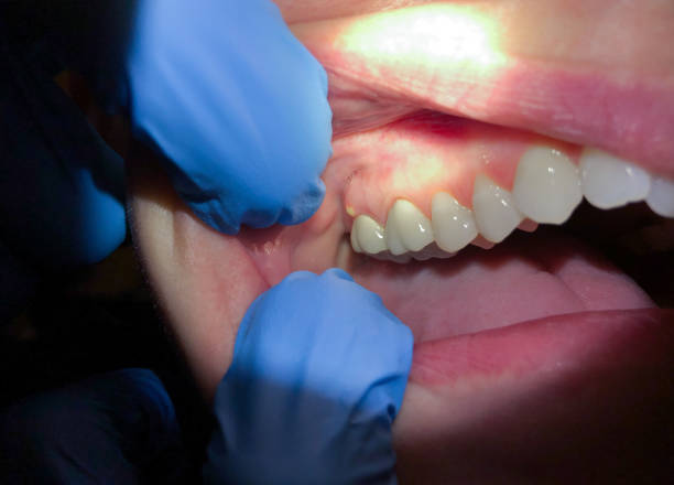 Best Emergency Dentist for Lost Fillings or Crowns in Oberlin, KS